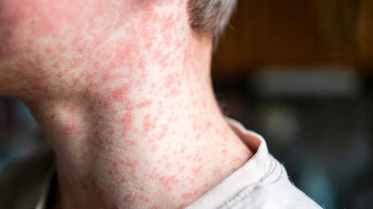 Measles Alerts 2026: Outbreaks Linked to International Airports and Tourist Hubs